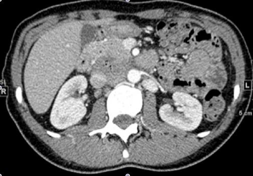 Rhabdoid Tumor of Ovary (SCCOHT)