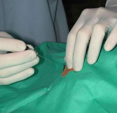 epidural analgesia palpate dorsal prominence