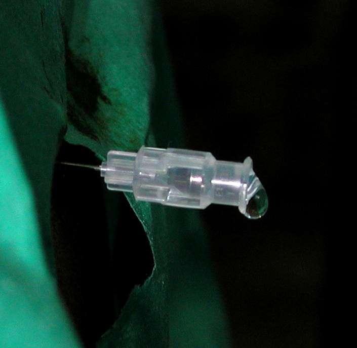 Injection of local anaesthetic into the CSF is often termed spinal anaesthesia. Compared to epidural anaesthesia, a smaller volume is used to avoid excessive cranial spread of the solution.