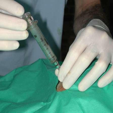 epidural analgesia loss of resistance test glass syringe or