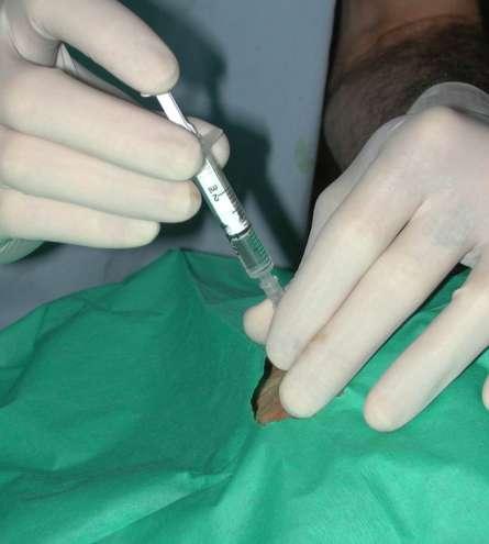 epidural analgesia inject drugs over 30-60 seconds onset of