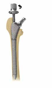 Attach the torque wrench to the taper disassembly tool and, with the anti-rotation handle attached to the neck of the proximal body, turn the torque wrench clockwise until the proximal body