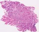 ECL cell hyperplasia