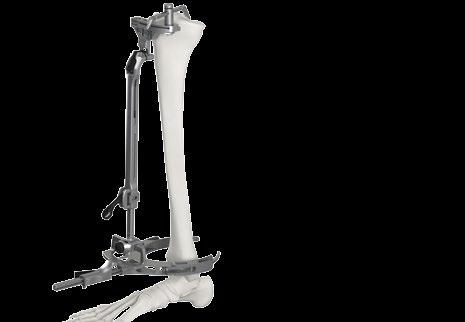 Femoral Preparation Tibial Preparation FIGURE 13 FIGURE 14 FIGURE 1 FIGURE 1A STANDARD PS BOX CUT (SAW AND CHISEL) The Modular Capture may be used in conjunction with the Standard PS Box Cut Guides