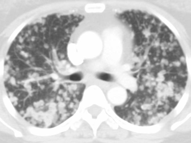 Diffuse adenocarcinoma Bilateral pulmonary disease à M1a M1b 8 th TNM M1c One extrathoracic