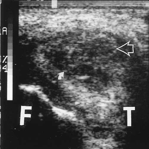 J Ultrasound Med 17:525 529, 1998 DIAZ ET AL 527 A Figure 2 Transverse sonograms, and corresponding linear diagrams, demonstrate swelling of the peroneus longus tendon