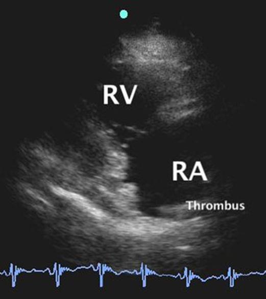 The apical four chamber view revealed a dilated right ventricle with apical and basal segment contractions with bulging out of the mid-right ventricle (McConnell sign) and color Doppler evacuation