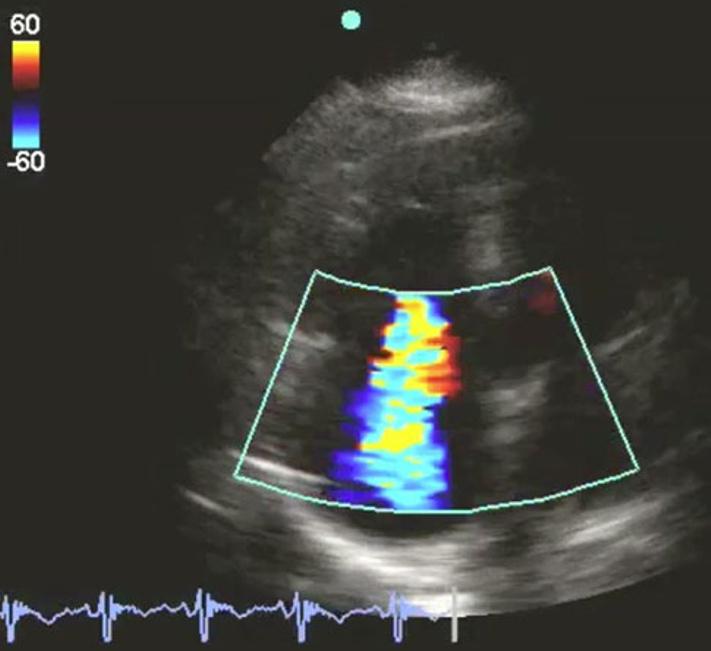 Crit Ultrasound J (2011) 3:155 160 157 Fig. 4 Apical four chamber view McConnell sign Fig. 6 Tricuspid regurgitation apical 4 view-cw Doppler Fig. 7 Apical four-tissue Doppler of right ventricle Fig.