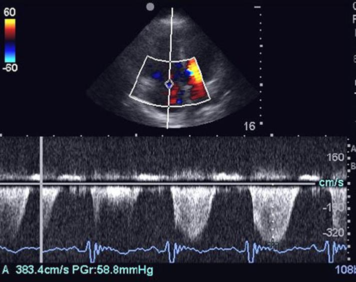 The patient subsequently had a formal computed tomography angiogram of the chest evaluation performed by the Radiology department that revealed massive pulmonary emboli in the left and right main