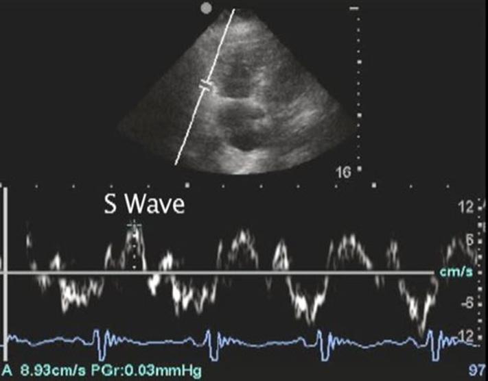 regurgitation and tricuspid regurgitation and an estimated right ventricular systolic pressure, RVSP, of 75 mmhg.