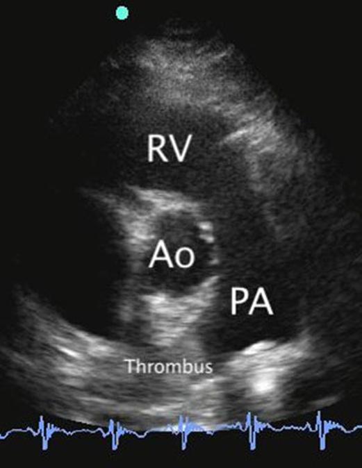 158 Crit Ultrasound J (2011) 3:155 160 Fig. 10 Inferior vena cava into right atrium Fig. 8 RVOT view-direct visualization of thrombus in PA Fig.