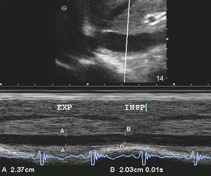 tachycardic and hypotensive [1 15]. At the patient s bedside in the ED, we were able to directly visualize an occlusive thrombus in the patient s right Fig.
