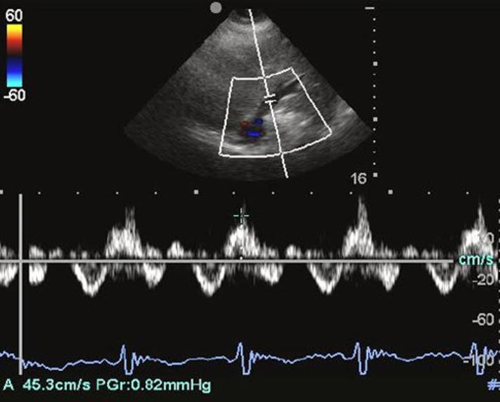 ED physician performed bedside echocardiography which was a very useful tool to allow us to expedite medical therapy and obtain early ED surgical consultation.