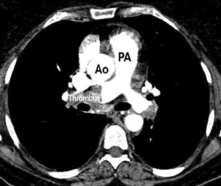 Crit Ultrasound J (2011) 3:155 160 159 Fig. 12 Popliteal deep venous thrombosis Fig. 13 CT scan of massive pulmonary embolism plasminogen activator administration.