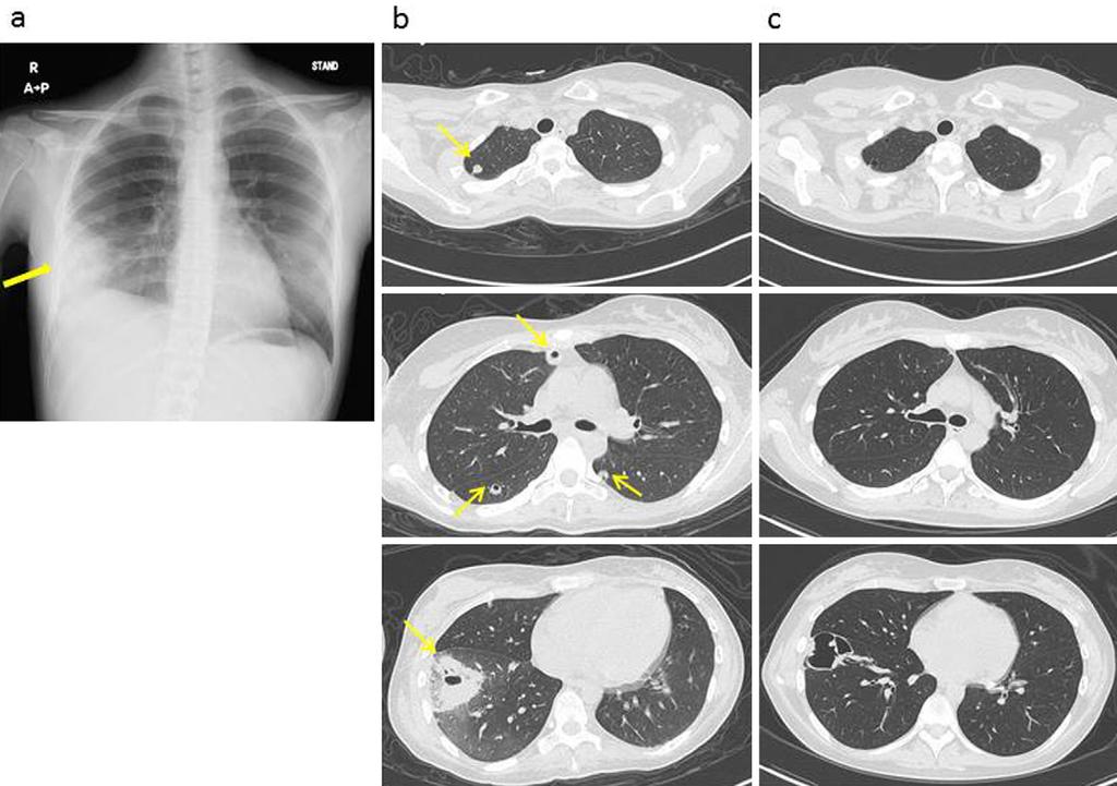 Figure 1. Diagnostic chest imaging. a: A chest X-ray obtained on the 25th day after admission revealed a nodular shadow in the right lower lung field.