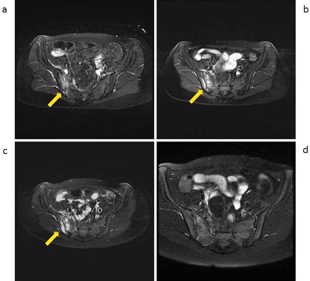 Figure 2. Sacroiliac MRI findings. a: MRI of the pelvis revealed a high-intensity area in the right sacroiliac joint, compatible with the findings of sacroiliitis due to MRSA infection.