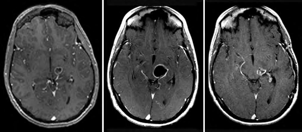 REVIEW Rosenfeld/Albright/Pruitt FIGURE 1 Pseudoprogression after chemoradiation. MRI of a biopsy-proven grade III astrocytoma before treatment (left panel).