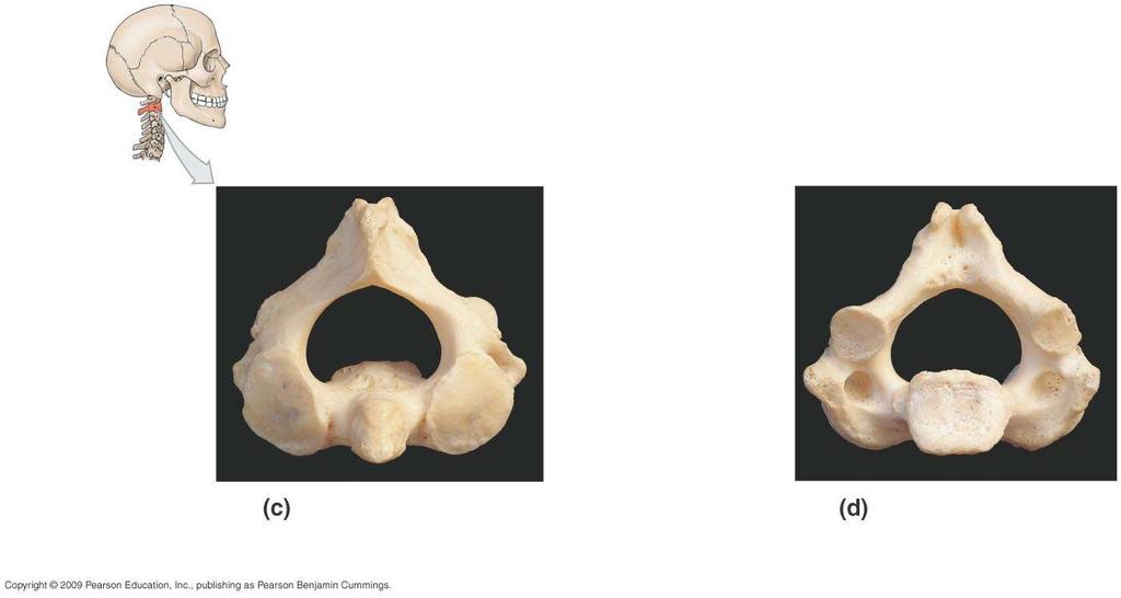 2 nd cervical vertebra (C2) or axis Spinous Transverse articular facet Lamina Transverse Pedicle body Inferior articular
