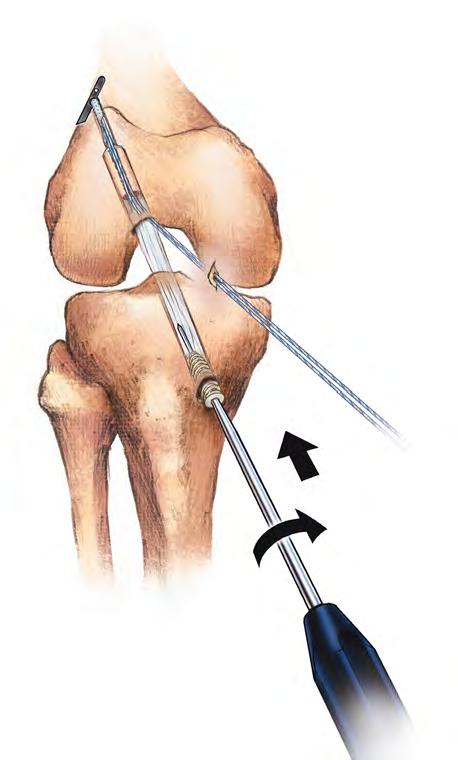 10 BTB ACL Reconstruction with ToggleLoc Fixation Device Surgical Technique Figure 19 Figure 18 Figure 20 Complete Tibial Fixation Tension the graft by manually pulling on the sutures attached to the