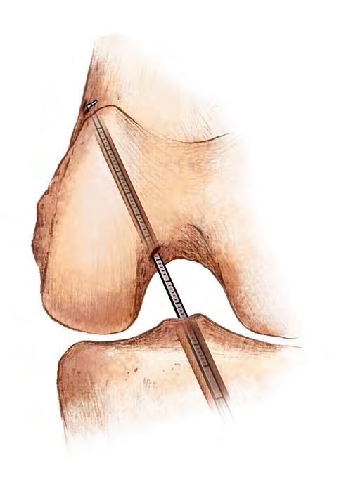 femoral tunnel (Figure 3). Re-insert the guide wire into the femoral tunnel and out the skin of the lateral thigh.