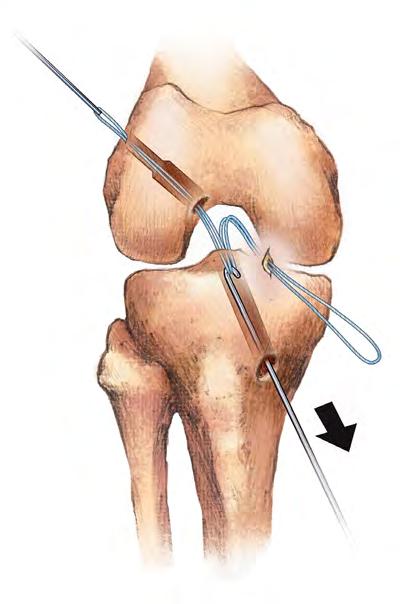 7 BTB ACL Reconstruction with ToggleLoc Fixation Device Surgical Technique Figure 10 Figure 11 Figure 12 Relay Suture Technique if Utilizing the Medial Portal Procedure Thread a strand of relay