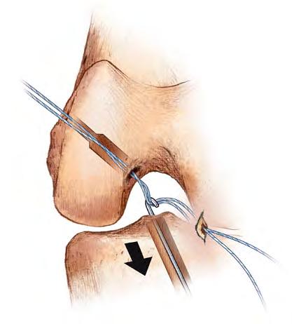 Pull proximally on the graft passing pin to pull the relay suture through the skin. Use a suture grasper or crochet hook (Figure 11) to retrieve the relay suture through the tibial tunnel (Figure 12).
