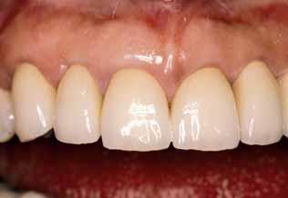 Maynard and Wilson, 1979; Parma-Benfenati et al, 1985; Tarnow et al, 1986; Wilson and Maynard, 1981). Proper embrasure space must be restored to promote periodontal health and esthetic appearance.