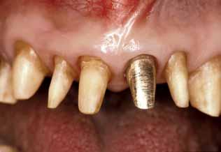 2b Equigingival tooth preparation.