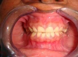 8. Binkley TK, Binkley CJ. A practical approach to full mouth rehabilitation. J Prosthet Dent 1987; 57:261-6. 9. Hobo S, Takayama H.