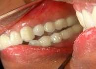 Intra oral view of
