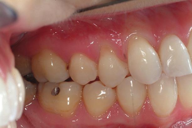 The oblique smile demonstrates the uprighted incisors and reduction