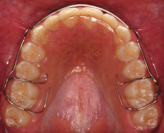 Scheibe and Ruf retrospectively assessed 1,062 patients with lower bonded retainers for an average retention period of approximately 3 years.