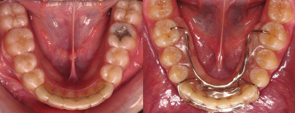FIGURE 4. Overlay mandibular retainers. (Left) Clear thermoplastic retainer over fixed mandibular retainer bonded to all anterior teeth.