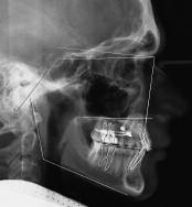 Wilmes/Drescher WORLD JOURNAL OF ORTHODONTICS Fig 8 Superimposition of pre- and postdistal movement cephalograms. Clinical example with spider screw mini-implants (treatment duration 10 months).