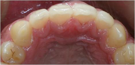 Design with gingival offset ORMCO 7G