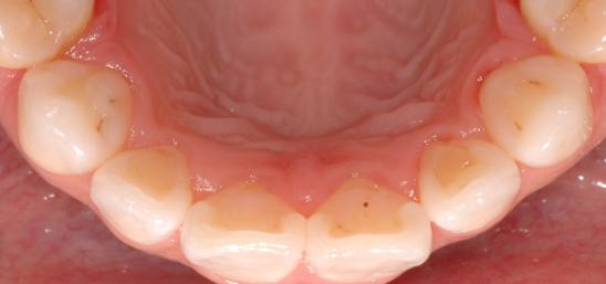 Periodontal irritation Just after