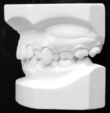 This case of complete transposition of the maxillary canine and premolar was treated with