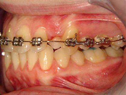 A unilaterally activated transpalatal arch was used to move the premolar labially, back to