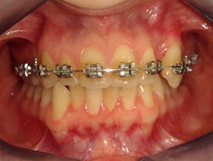 An open coil was placed between the maxillary right canine and second premolar to gain enough