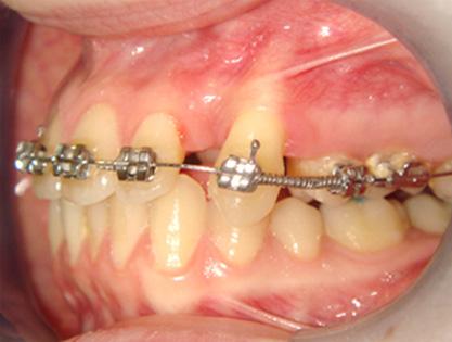 Bite raising was achieved by bonding composite on the occlusal surfaces of both mandibular