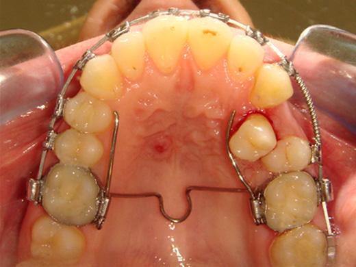 By 18 months, the maxillary left first premolar was included in the fixed mechanics.