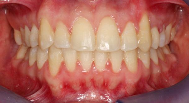 At the 2-year follow-up, the patient had a stable occlusion, and the results of the orthodontic treatment were maintained.