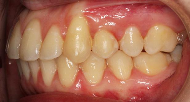 DISCUSSION Dental and facial esthetics of the maxillary anterior teeth should be carefully evaluated and considered when deciding which treatment option to follow.