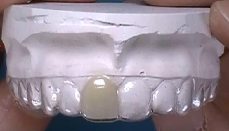 Invisible Retainer with Single-Tooth Pontic Fabrication Technique (Multi-Tooth Pontic