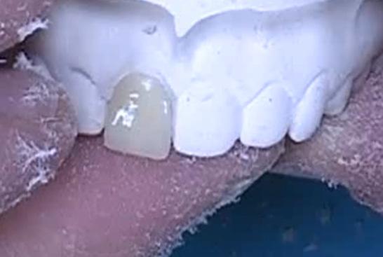 Usually, the plastic teeth require some adjustment.