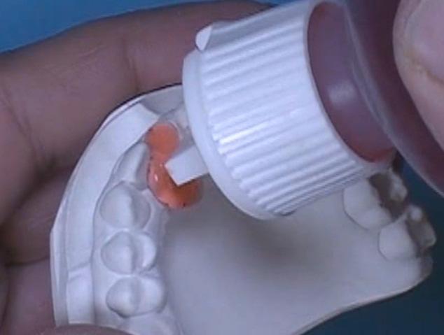 Trim along mesial and distal sides of the pontic to fit in the edentulous area.