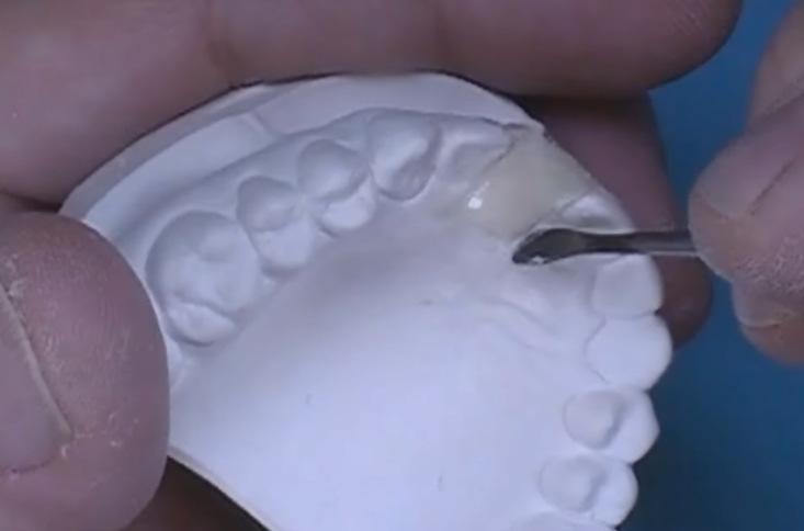 tooth shade polymer is used with clear monomer. Also a tissue-toned polymer may be used.
