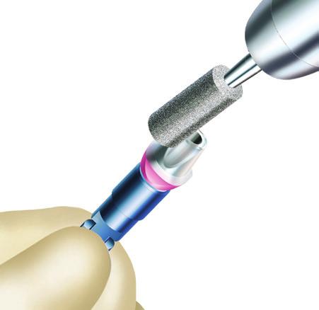 Cement-Retained Restorations a. LAB PREPARATION OF THE ESTHETIC CONTOUR TI ABUTMENT LABORATORY SECTION Laboratory Cast Fabrication Pour the soft tissue around the implant analog.
