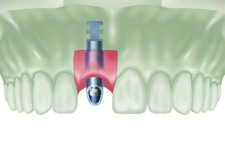 Cement-Retained Restorations Place the UCLA Gold/Plastic Abutment on the laboratory cast. Determine the modifications needed to provide adequate clearance for adjacent and opposing dentition.