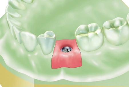Screw-Retained Restorations UCLA Abutment System The UCLA Gold/Plastic Abutment is recommended for fabrication of a customized abutment for both screw- and cement-retained restorations, using regular
